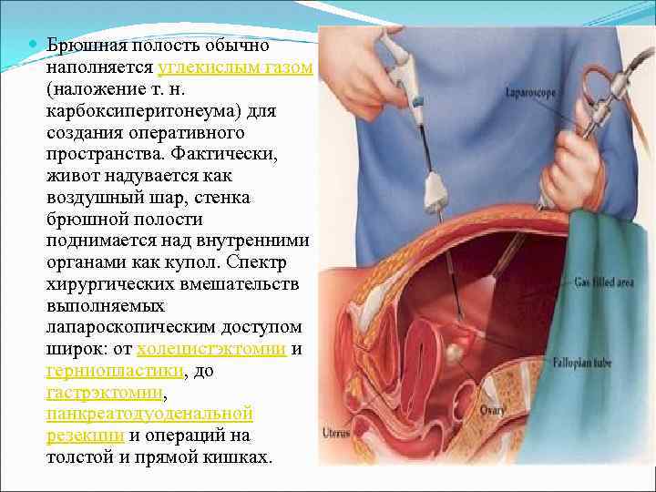  Брюшная полость обычно наполняется углекислым газом (наложение т. н. карбоксиперитонеума) для создания оперативного