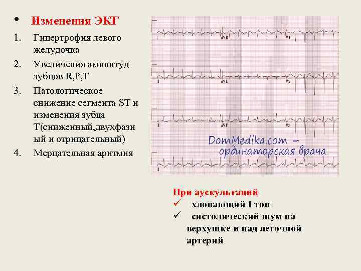  • Изменения ЭКГ 1. 2. 3. 4. Гипертрофия левого желудочка Увеличения амплитуд зубцов