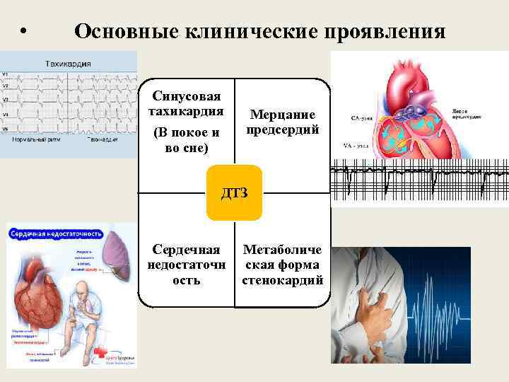  • Основные клинические проявления Синусовая тахикардия (В покое и во сне) Мерцание предсердий