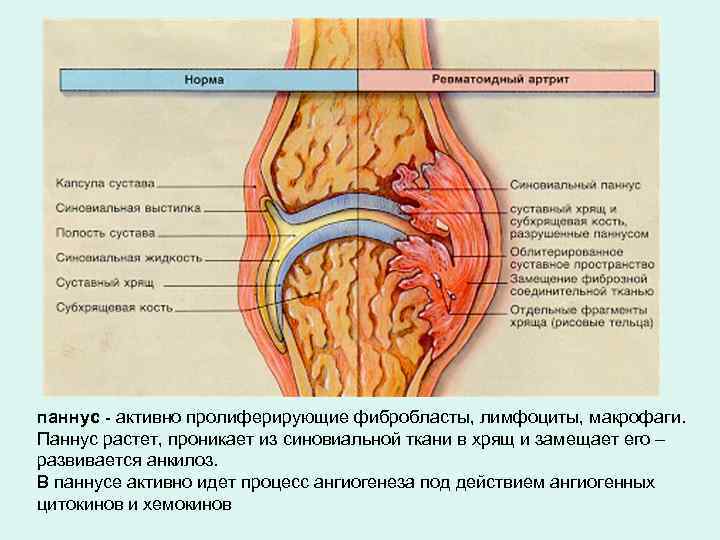 паннус - активно пролиферирующие фибробласты, лимфоциты, макрофаги. Паннус растет, проникает из синовиальной ткани в