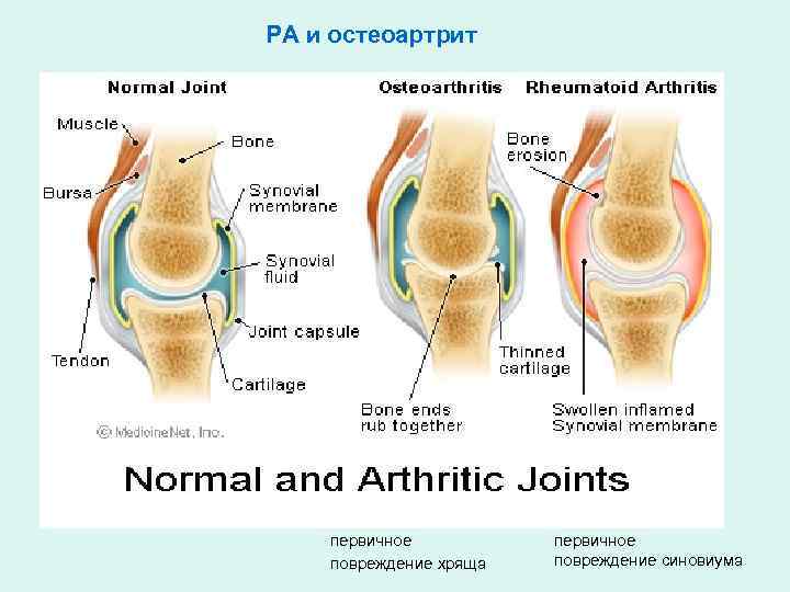 РА и остеоартрит первичное повреждение хряща первичное повреждение синовиума 