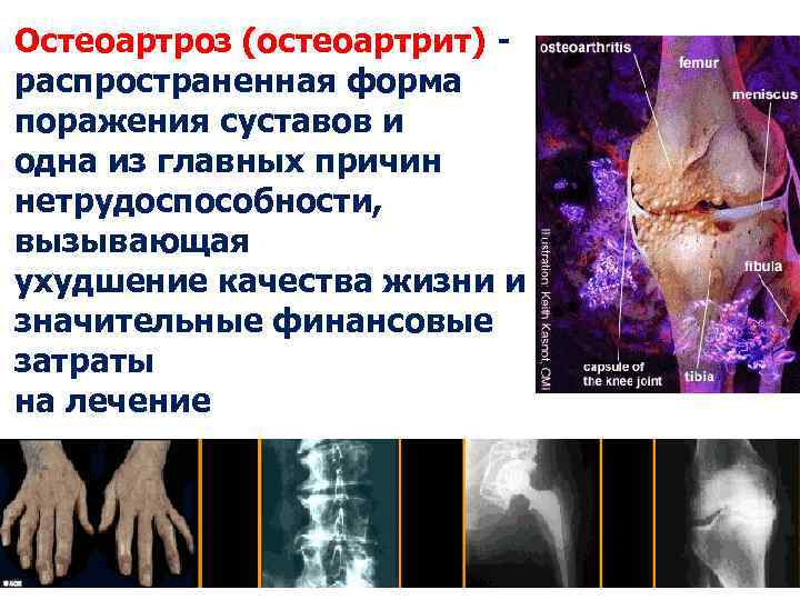 Остеоартроз (остеоартрит) - распространенная форма поражения суставов и одна из главных причин нетрудоспособности, вызывающая