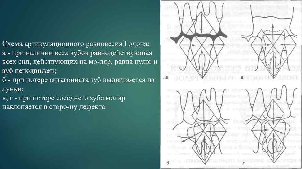 Схема артикуляционного равновесия Годона: а при наличии всех зубов равнодействующая всех сил, действующих на