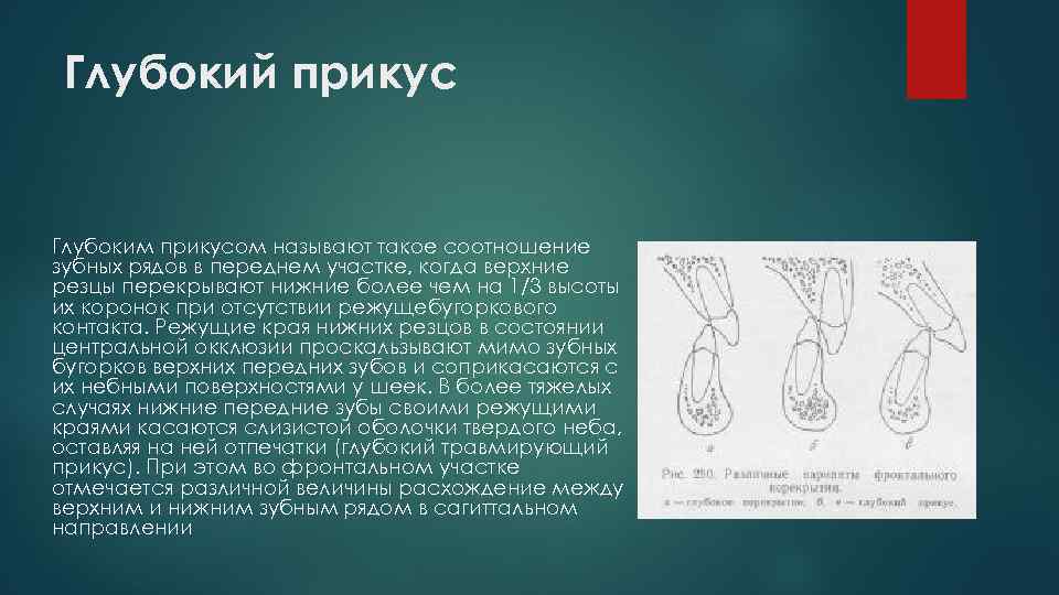 Глубокий прикус Глубоким прикусом называют такое соотношение зубных рядов в переднем участке, когда верхние