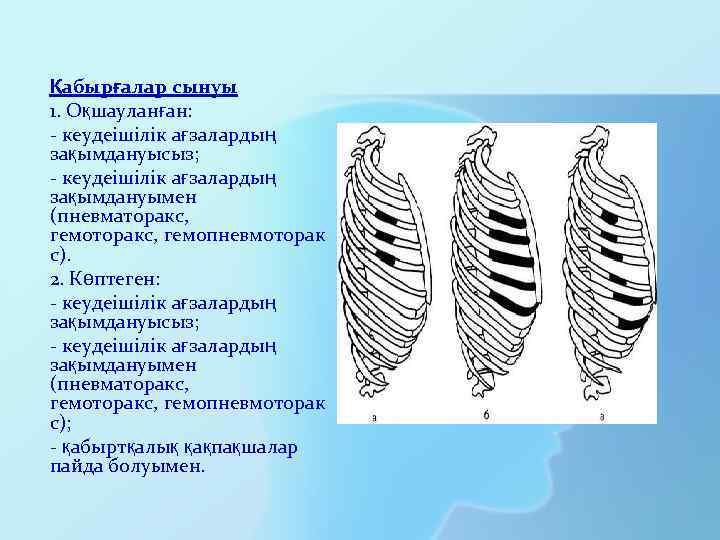 Қабырғалар сынуы 1. Оқшауланған: - кеудеішілік ағзалардың зақымдануысыз; - кеудеішілік ағзалардың зақымдануымен (пневматоракс, гемоторакс,