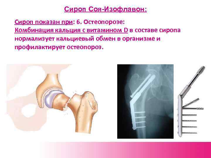 Сироп Соя-Изофлавон: Сироп показан при: 6. Остеопорозе: Комбинация кальция с витамином D в составе