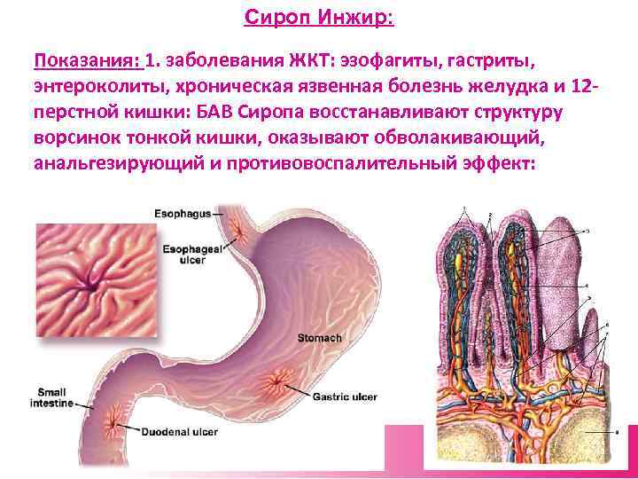 Сироп Инжир: Показания: 1. заболевания ЖКТ: эзофагиты, гастриты, энтероколиты, хроническая язвенная болезнь желудка и
