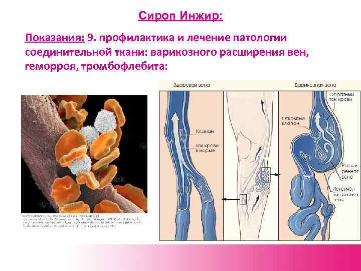Сироп Инжир: Показания: 9. профилактика и лечение патологии соединительной ткани: варикозного расширения вен, геморроя,