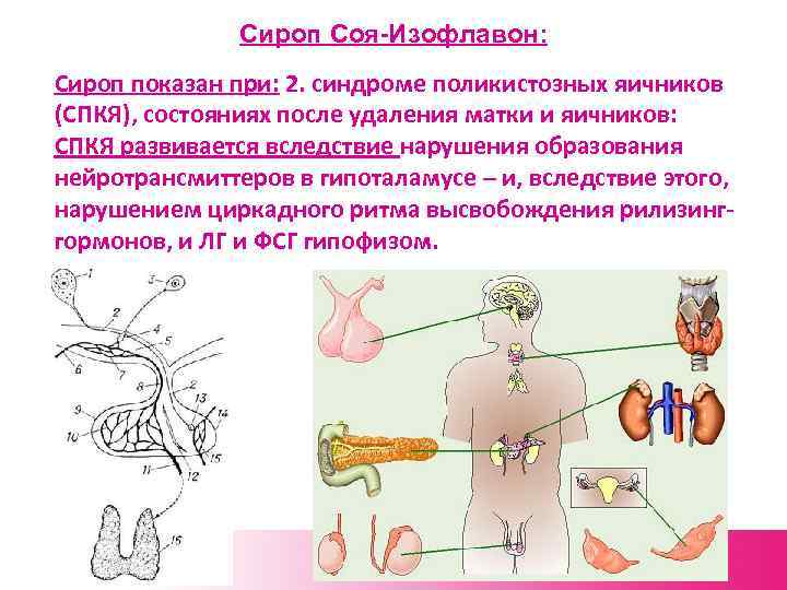 Сироп Соя-Изофлавон: Сироп показан при: 2. синдроме поликистозных яичников (СПКЯ), состояниях после удаления матки