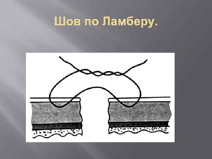 Шов по Ламберу. 