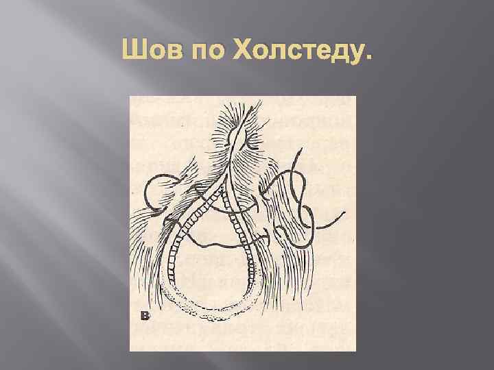 Шов по Холстеду. 