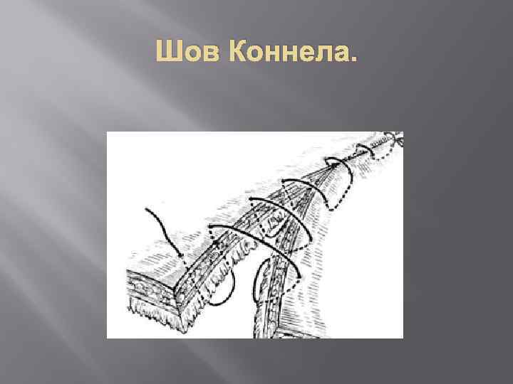 Шов Коннела. 