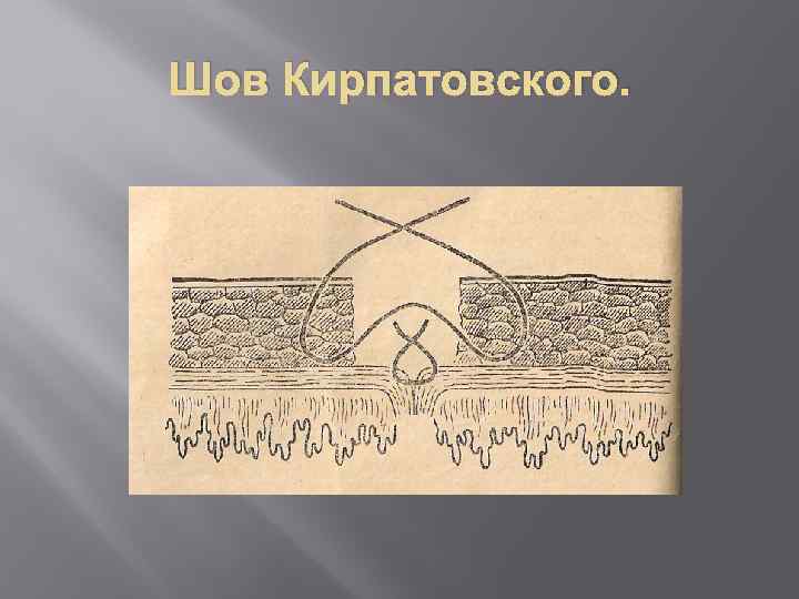 Шов Кирпатовского. 