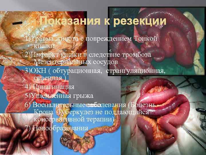 Показания к резекции 1)Травма живота с повреждением Тонкой кишки 2)Инфаркт кишки в следствие тромбоза