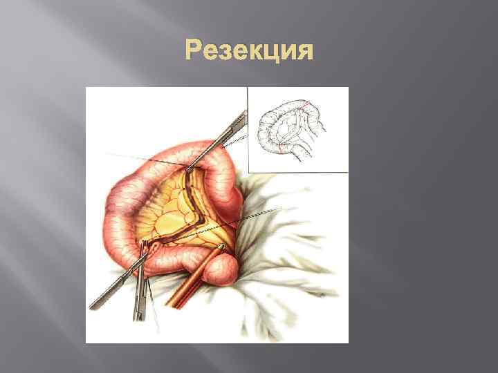Резекция 