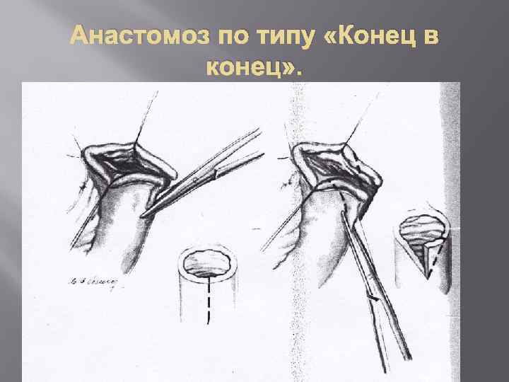 Анастомоз по типу «Конец в конец» . 