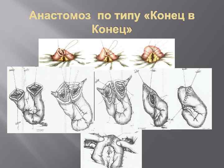 Анастомоз по типу «Конец в Конец» 