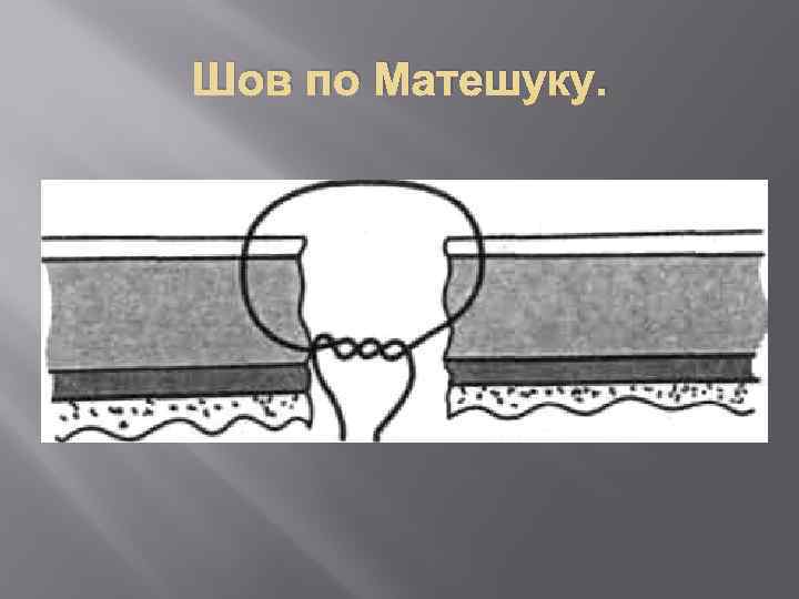 Шов по Матешуку. 