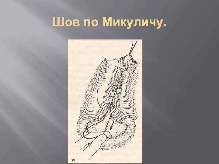 Шов по Микуличу. 