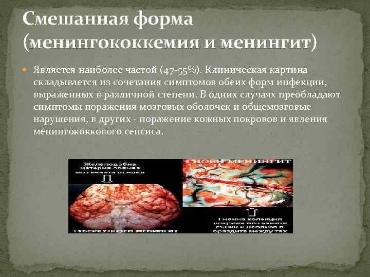 Смешанная форма (менингококкемия и менингит) Является наиболее частой (47 -55%). Клиническая картина складывается из