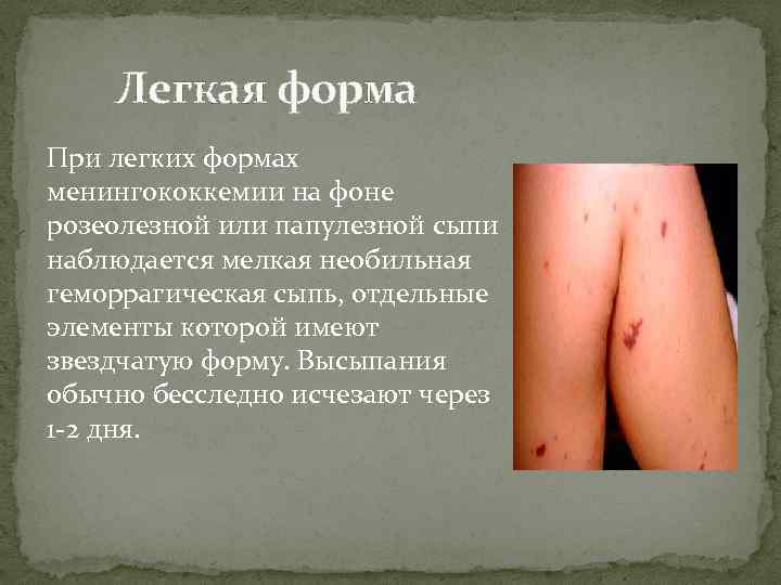 Легкая форма При легких формах менингококкемии на фоне розеолезной или папулезной сыпи наблюдается мелкая