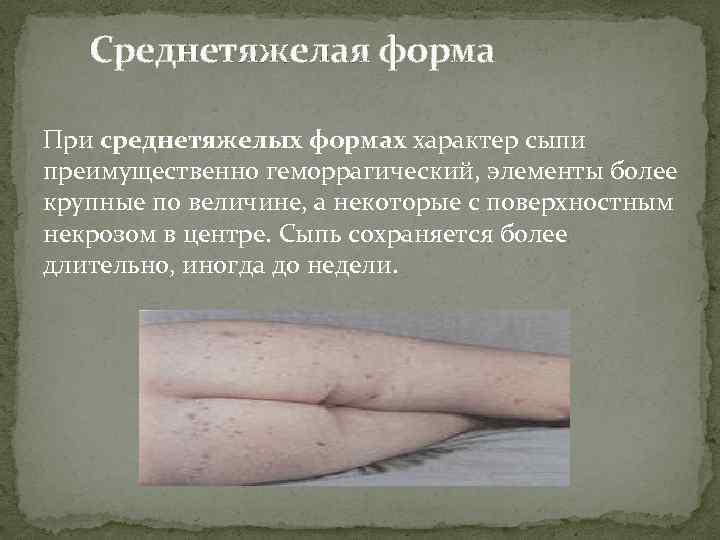 Среднетяжелая форма При среднетяжелых формах характер сыпи преимущественно геморрагический, элементы более крупные по величине,
