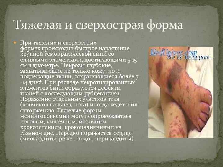 Тяжелая и сверхострая форма При тяжелых и сверхострых формах происходит быстрое нарастание крупной геморрагической
