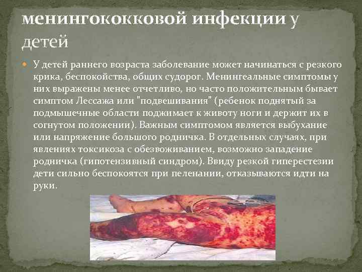 менингококковой инфекции у детей У детей раннего возраста заболевание может начинаться с резкого крика,