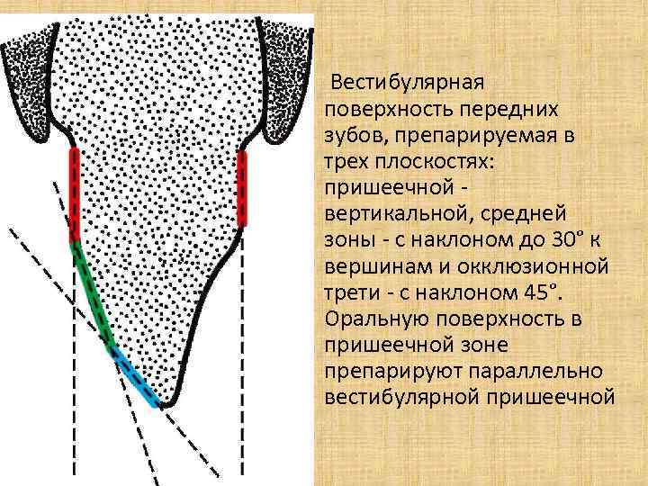  • Вестибулярная поверхность передних зубов, препарируемая в трех плоскостях: пришеечной - вертикальной, средней