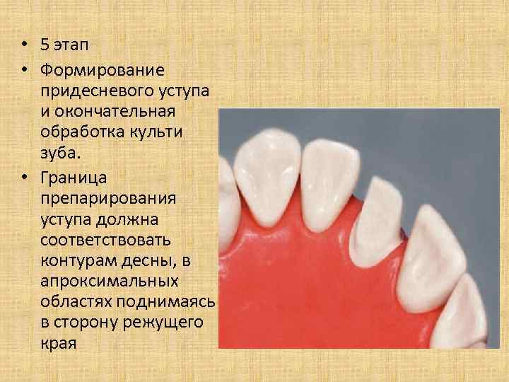  • 5 этап • Формирование придесневого уступа и окончательная обработка культи зуба. •