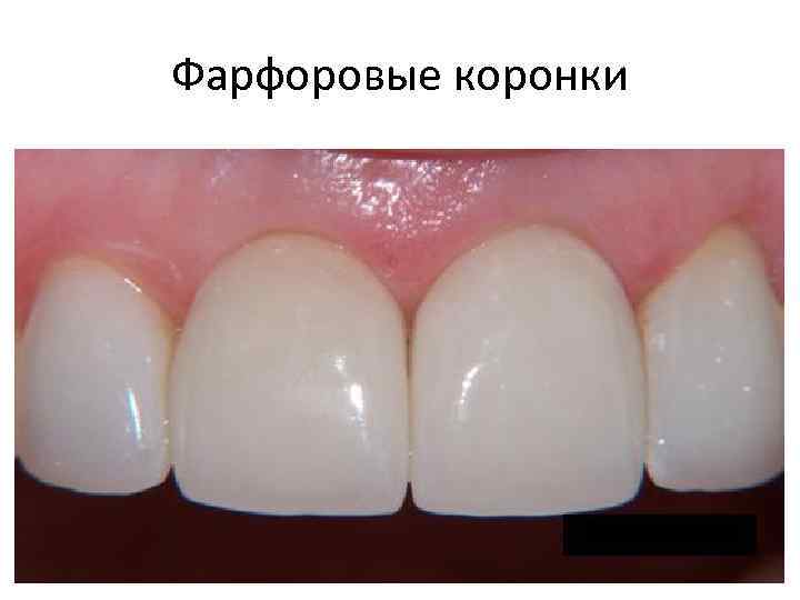 Фарфоровые коронки 