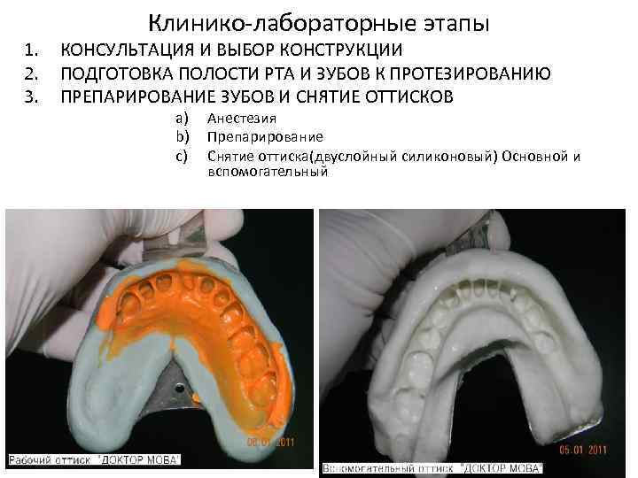 1. 2. 3. Клинико-лабораторные этапы КОНСУЛЬТАЦИЯ И ВЫБОР КОНСТРУКЦИИ ПОДГОТОВКА ПОЛОСТИ РТА И ЗУБОВ