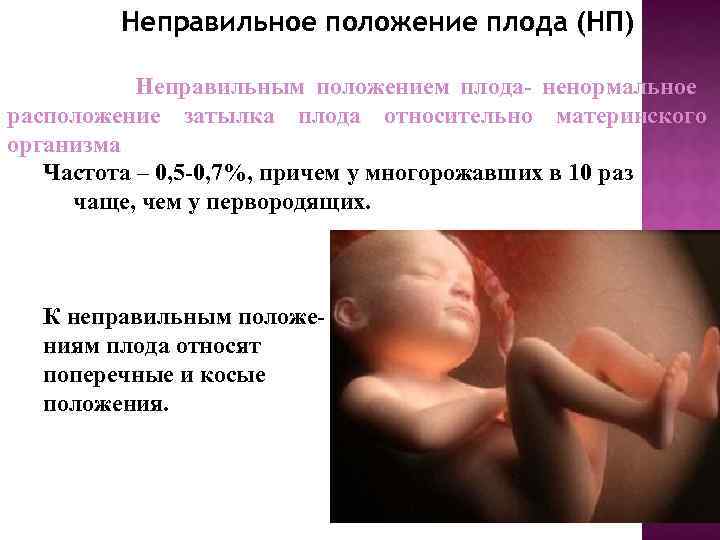 Неправильные положения плода презентация