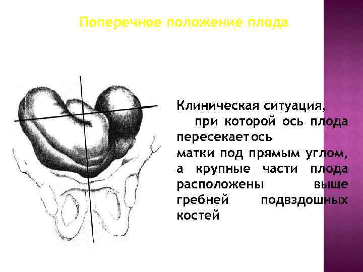 Крупные части плода. Поперечное положение плода. Поперечное и косое положение. Запущенное поперечное положение.