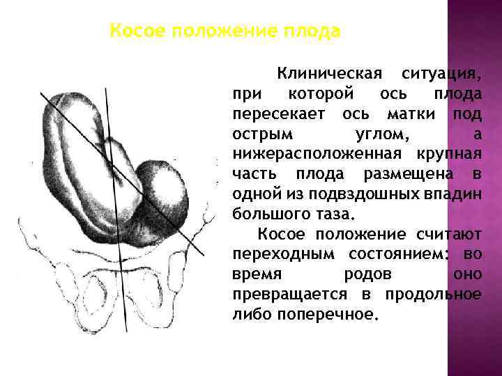 Предлежание плода на 30 неделе беременности. Косое предлежание плода на 30 неделе. Поперечное расположение плода на 30 неделе. Предлежание плода при беременности косое и поперечное. Поперечное расположение плода на 30 неделе беременности.