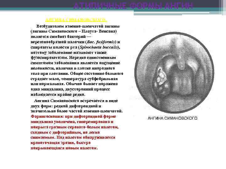 АТИПИЧНЫЕ ФОРМЫ АНГИНА СИМАНОВСКОГО. Возбудителем язвенно пленчатой ангины (ангины Симановского – Плаута Венсана) является