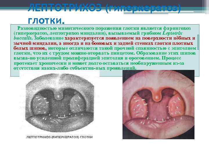 ЛЕПТОТРИХОЗ (гиперкератоз) глотки. Разновидностью микотического поражения глотки является фарингохоз (гиперкератоз, лептотрихоз миндалин), вызываемый грибком