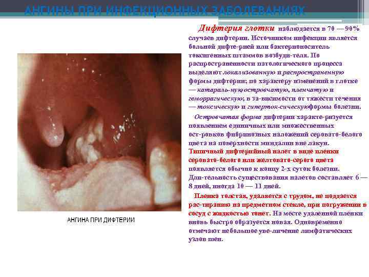 АНГИНЫ ПРИ ИНФЕКЦИОННЫХ ЗАБОЛЕВАНИЯХ Дифтерия глотки наблюдается в 70 — 90% случаев дифтерии. Источником