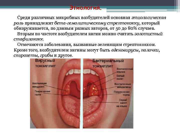 Этиология. Среди различных микробных возбудителей основная этиологическая роль принадлежит бета-гемолитическому стрептококку, который обнаруживается, по