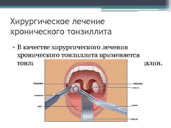 Хирургическое лечение хронического тонзиллита • В качестве хирургического лечения хронического тонзиллита применяется тонзиллэктомия -