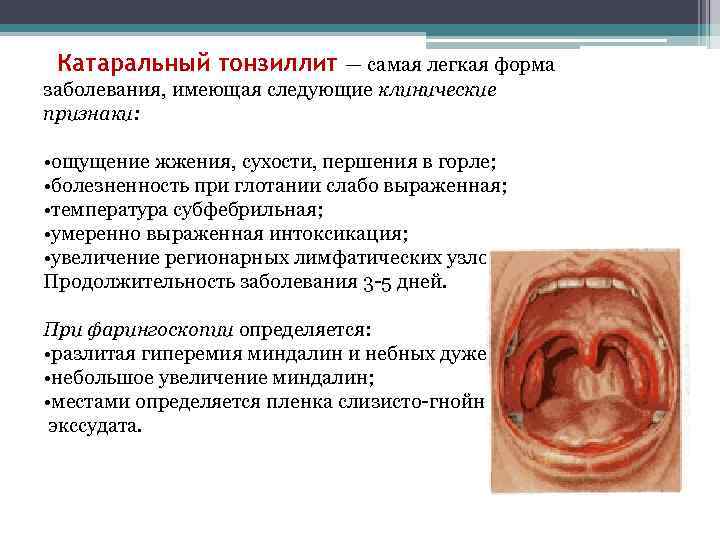 Катаральный тонзиллит — самая легкая форма заболевания, имеющая следующие клинические признаки: • ощущение жжения,