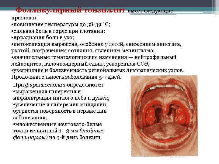 Фолликулярный тонзиллит имеет следующие признаки: • повышение температуры до 38 -39 °С; • сильная