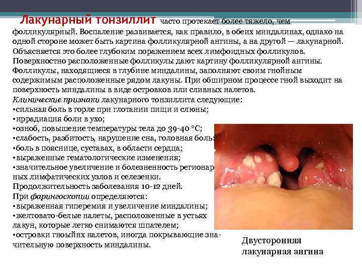 Лакунарный тонзиллит часто протекает более тяжело, чем фолликулярный. Воспаление развивается, как правило, в обеих