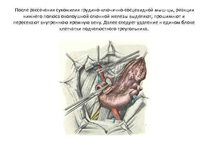 После рассечения сухожилия грудино ключично сосцевидной мыш цы, реакции нижнего полюса околоушной слюнной железы