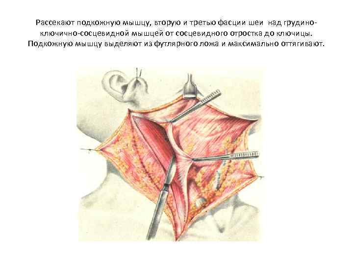 Рассекают подкожную мышцу, вторую и третью фасции шеи над грудино ключично сосцевидной мышцей от