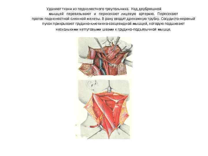 Удаляют ткани из подчелюстного треугольника. Над двубрюшной мышцей перевязывают и пересекают лицевую артерию. Пересекают