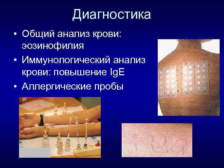 Диагностика • Общий анализ крови: эозинофилия • Иммунологический анализ крови: повышение Ig. Е •