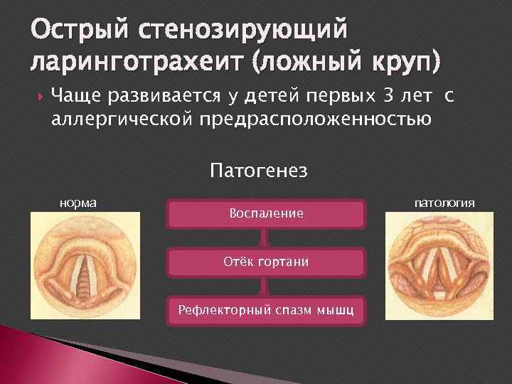 Острый стенозирующий ларинготрахеит (ложный круп) Чаще развивается у детей первых 3 лет с аллергической