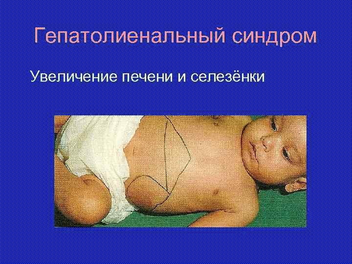 Гепатолиенальный синдром Увеличение печени и селезёнки 