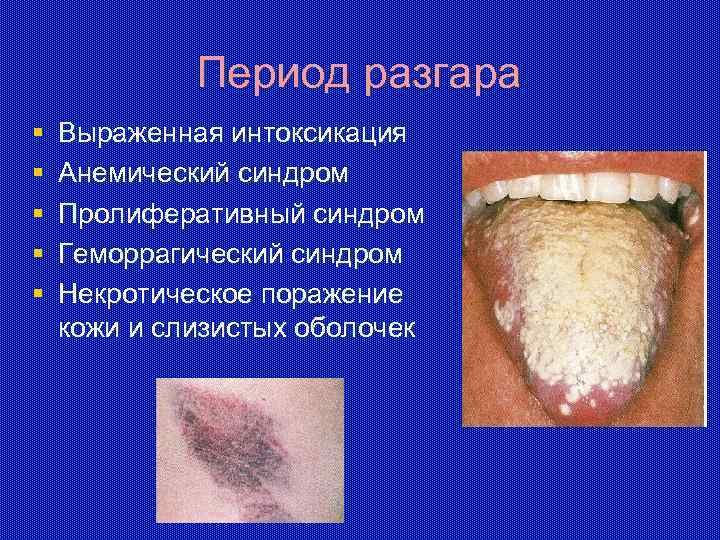 Период разгара § § § Выраженная интоксикация Анемический синдром Пролиферативный синдром Геморрагический синдром Некротическое